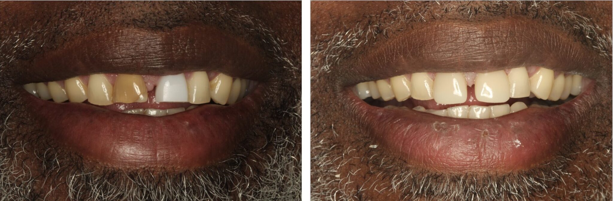 Side-by-side comparison of a male patient’s smile before and after Dr. Khandaqji replaced a discolored front tooth with a custom-matched porcelain crown at Mona Lisa Smile Dental.