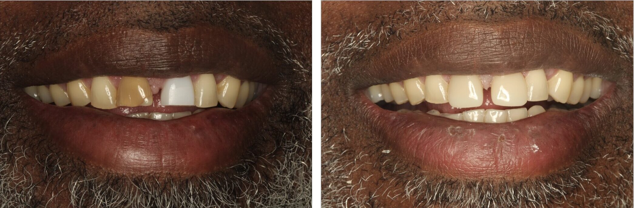 front teeth porcelain