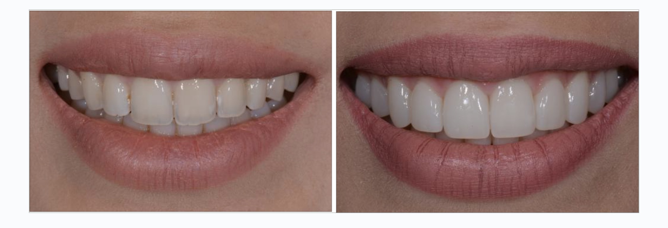 invisalign veneer