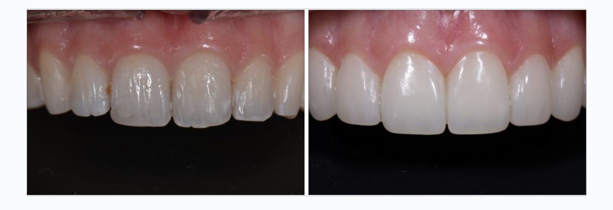 invisalign veneer