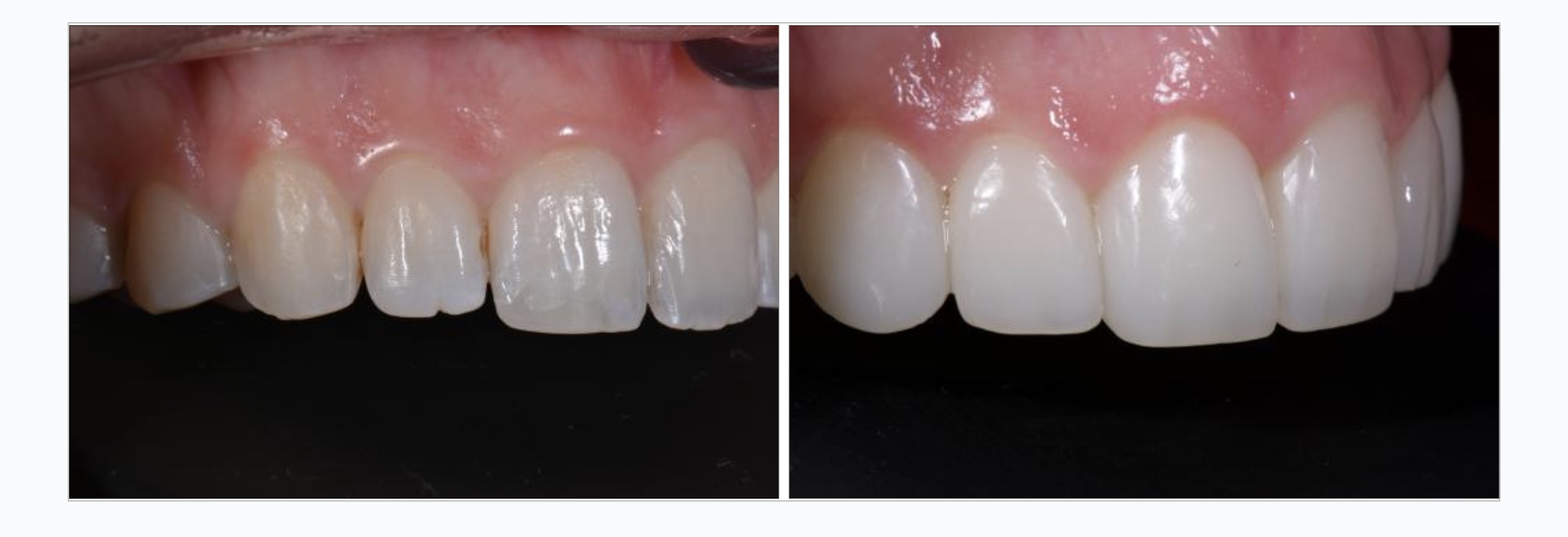 invisalign veneer