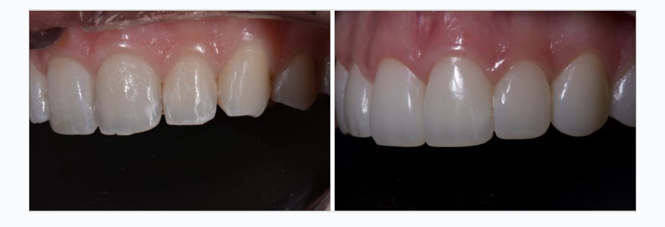 invisalign veneer