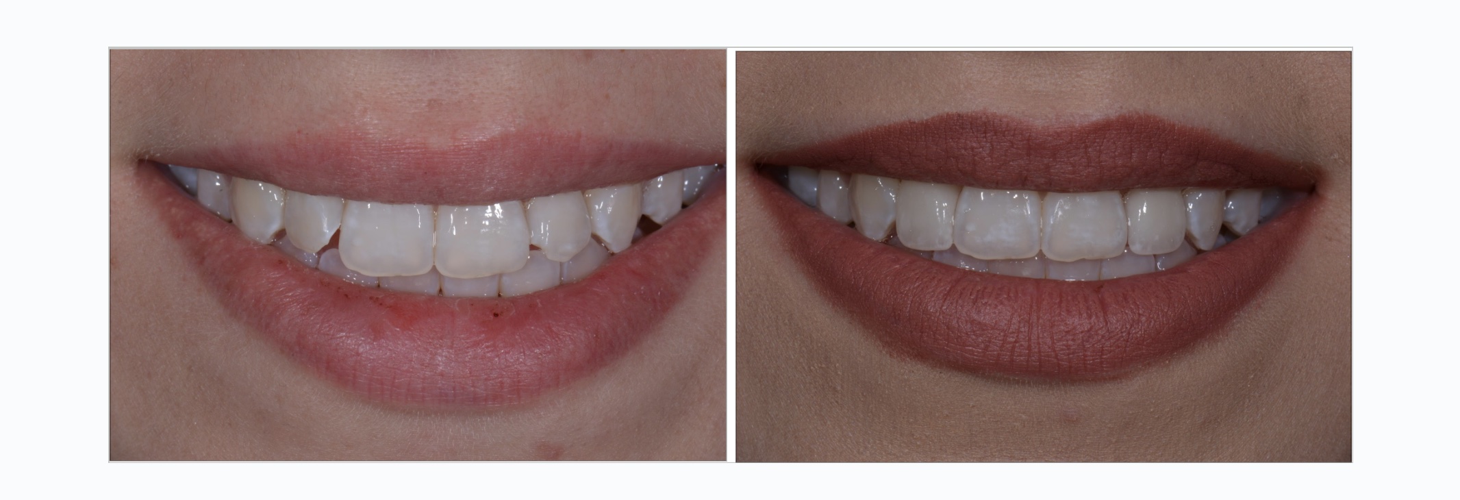 invisalign veneer