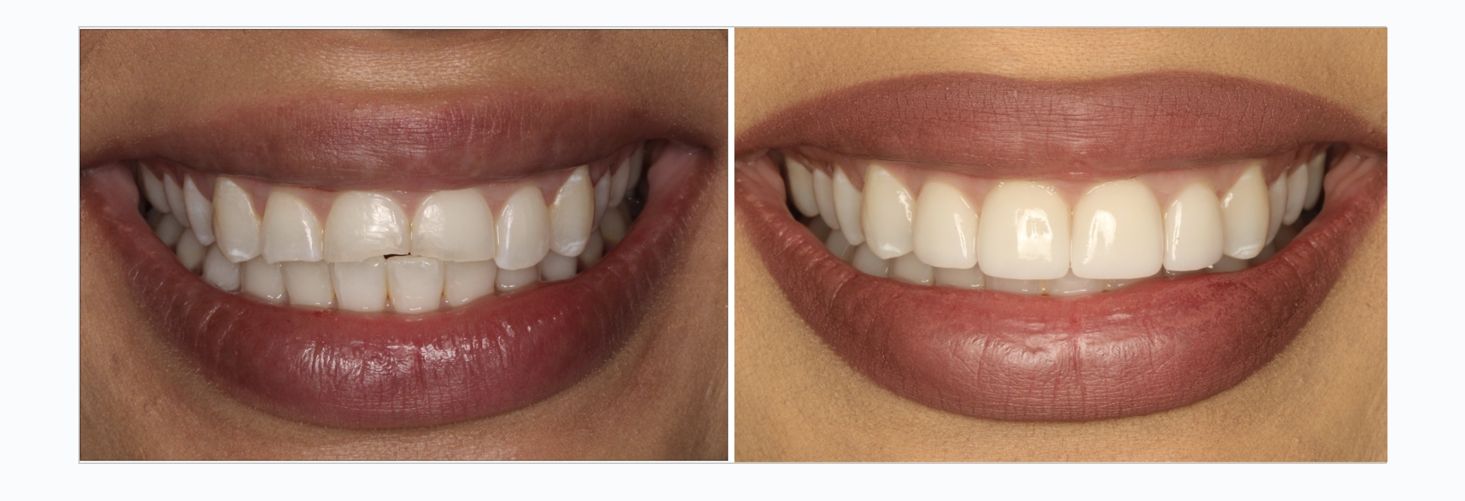 invisalign veneer