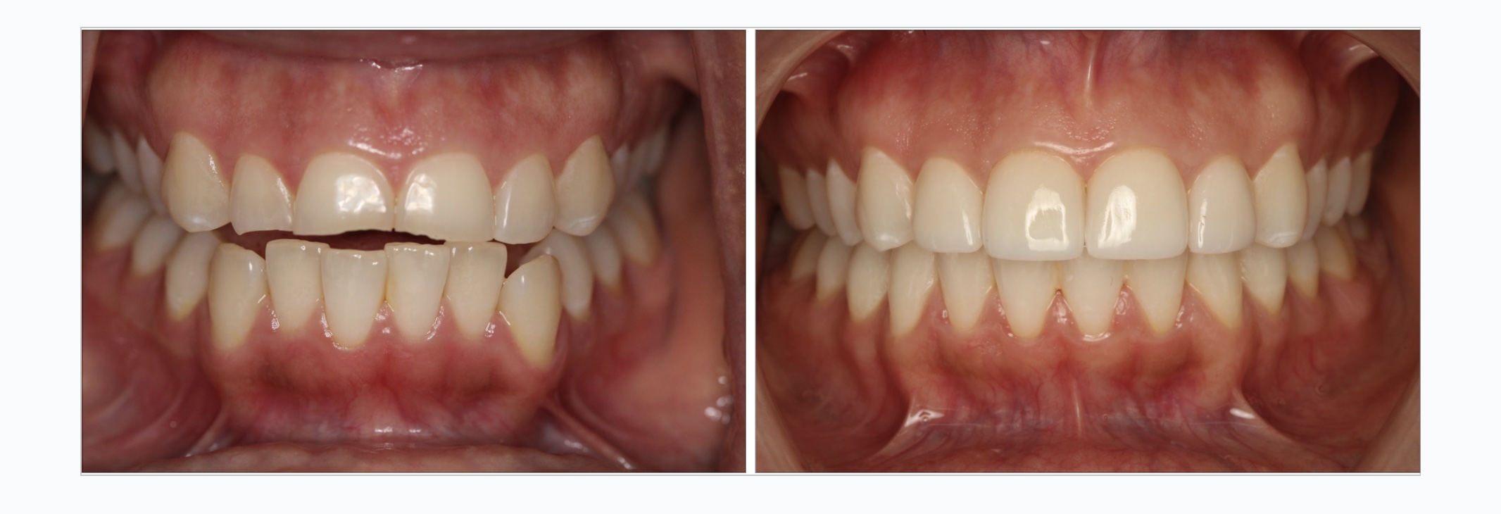 invisalign veneer