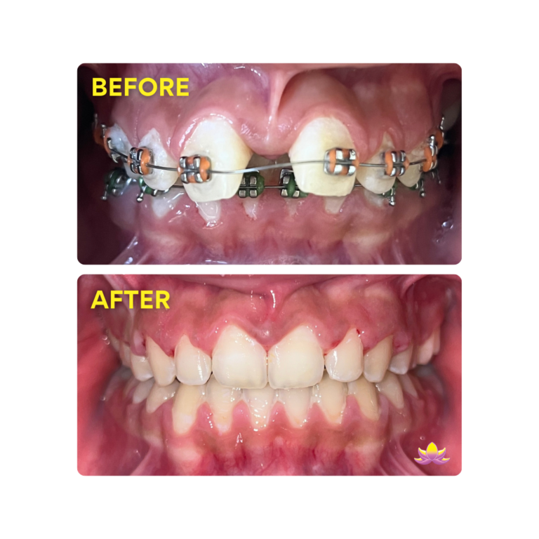Before and after Fastbraces® transformation by Dr. Mohammad Khadaniqji, Senior Master Provider at Mona Lisa Smile Dental, showing a straighter, confident smile.