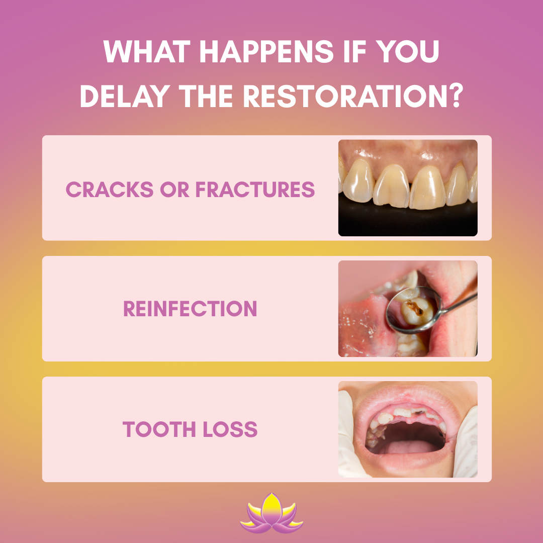 Crown or Filling After Root Canal? What to Know - Mona Lisa Smile Dental