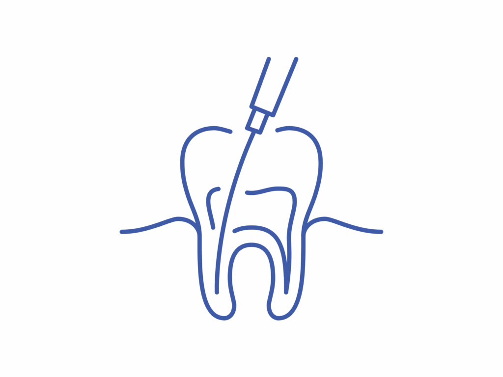 Root Canal Therapy