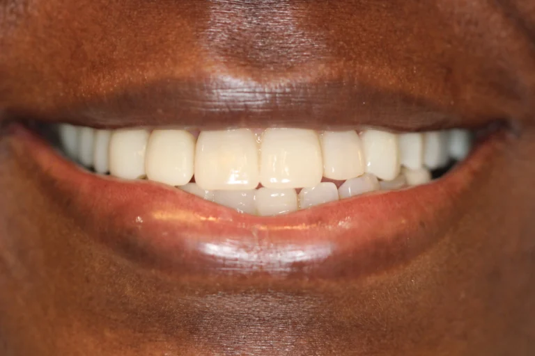 Close-up of a straight, healthy smile after Invisalign clear aligner treatment