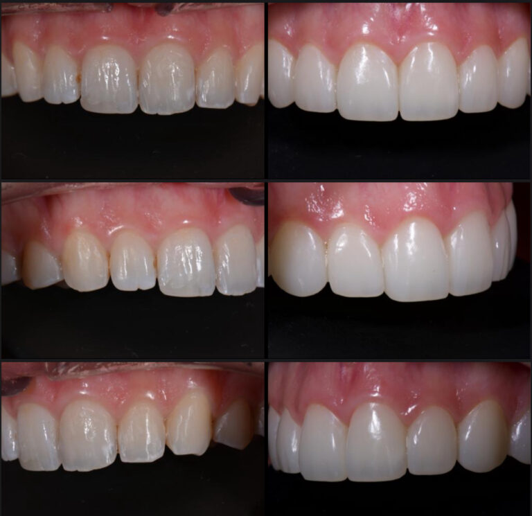 Before and after cosmetic dentistry veneers treatment at Mona Lisa Smile Dental, showing a natural, radiant smile transformation.